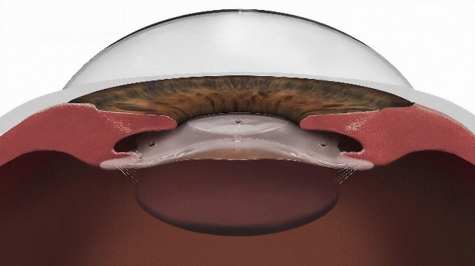澄欣眼科最新引進 EYECRYL 愛可逆後房式植入式隱形眼鏡